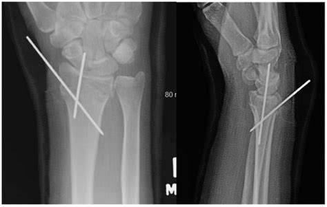 Migration of a K-wire from the distal radius to the heart