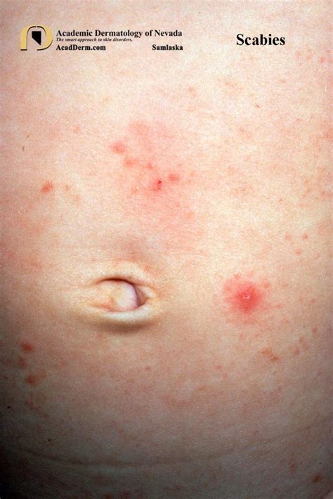 Mild Scabies On Stomach