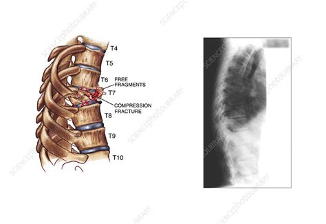 Mild T6 Compression Fracture