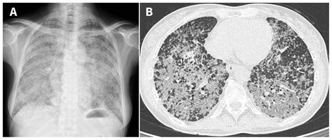 Miliary pattern on chest imaging as a presentation of EGFRnegative