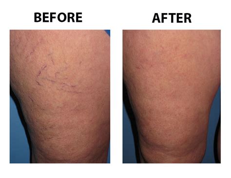 Miller vein. Request your free vein evaluation by completing the form. CALL NOW! 877-432-2184. REQUEST AN EVALUATION. Varicose Veins; Spider Veins; Lymphedema; Locations. Novi; Troy; Dearborn; Warren; Macomb; Auburn Hills ; Insurance; Our Physicians; Patient Portal; About Us. Join Our Team; Before & After Photos; Testimonials; Vein Quiz; News … 