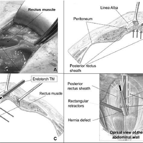 Mini open transhernial dissection in sublay plane with laparoscopic ...