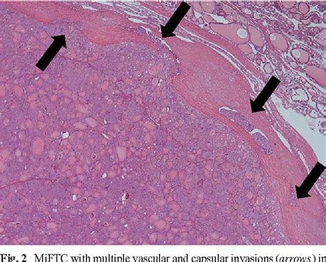 Minimally invasive follicular thyroid cancer (MIFTC)--a consensus ...