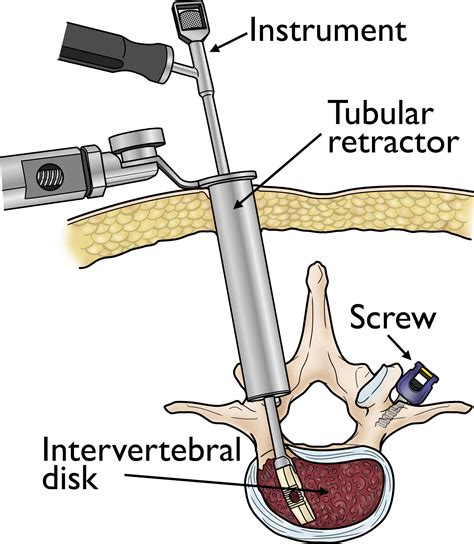 Minimally invasive spine surgery a practical guide to anatomy and techniques. - Arema manual for railway engineering 4shared.