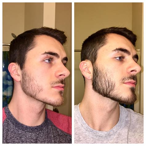 Minox beard. There's guys who grew terminal folicules in less time, just take a look in this sub, there's guys with 3 months with full terminal beards,also there's guys that are using for years and still don't have a full developed beard, genetic and age are two of the most important things that can influence in your minoxidil journey,naturally your beard will mature starting from … 