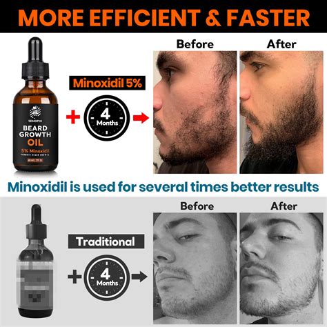 Minoxidil beard permanent or temporary.  If Minoxidil Beards are permanent, why should ...