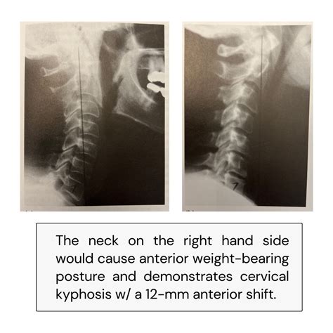 Misaligned c1 vertebra.  Discover Apr 25, 2025 · Upper cervical misalignment...