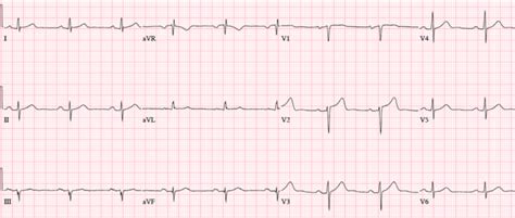 Misdiagnosis from ECG Lead Misplacement, Artifact and Lead Reversal …