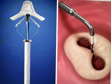 Mitraclip Procedure Video