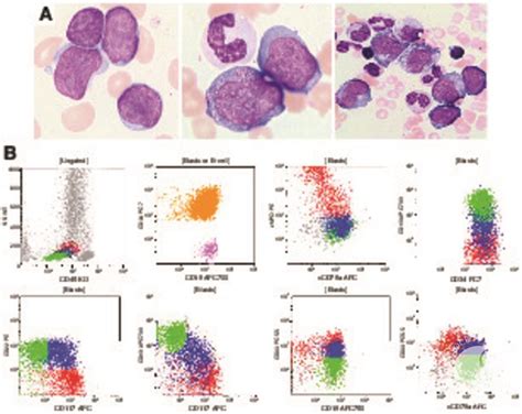 Mixed Phenotype/Lineage Leukemia: Has Anything Changed for …