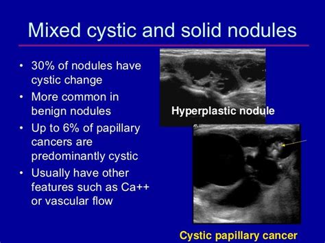 Mixed cystic and solid isoechoic thyroid nodule.  Includes standardized ...