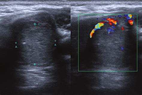 Mixed cystic and solid isoechoic thyroid nodule. .  <a href=https://cocktail-competition....