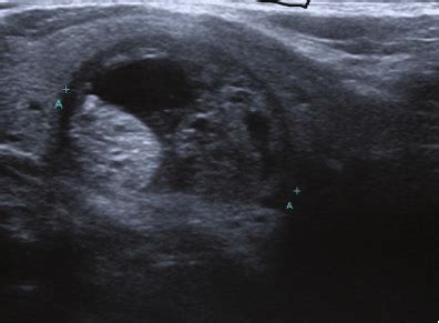 Mixed cystic and solid thyroid nodule ultrasound. .  <a href=https://door...