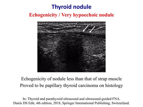 Mixed echogenicity nodule thyroid.  The cumulative score from all categories dete...