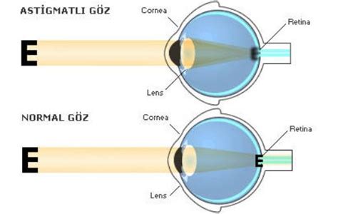 Miyop ve astigmat için lens