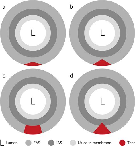 Model of a thirddegree OASIS. a superficial tear of the EAS b partial