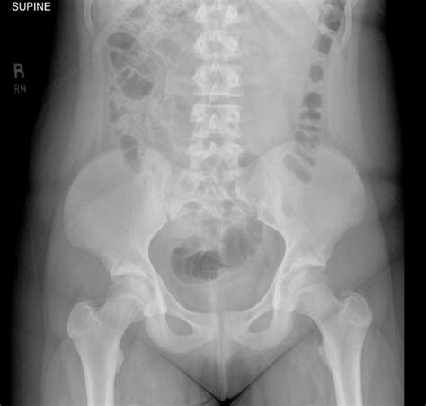 Moderate stool burden with nonobstructive bowel gas pattern