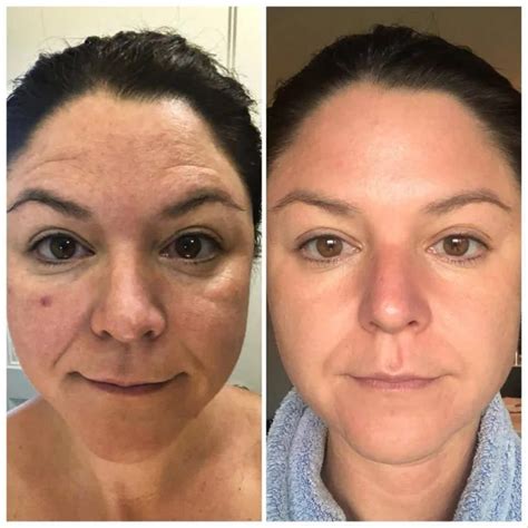 Modere before and after skin.  Modere offers several Liquid BioCell formulas; do they ...
