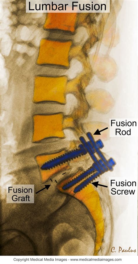 Modern Lumbar Spine Fusion Surgery Spine-health