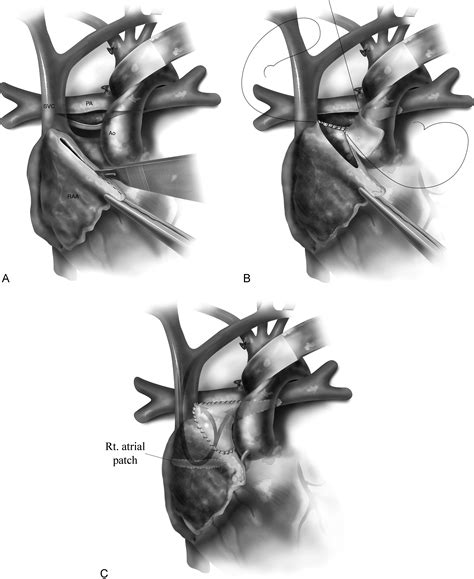 Modified HemiFontan Procedure Operative Techniques in Thoracic and