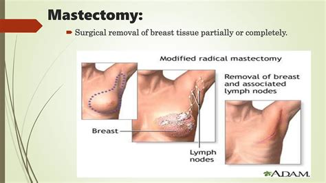 Modified Radical Mastectomy Definition Wikipedia