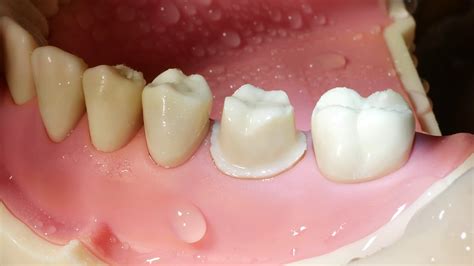 Molar Crown Preparation Walkthrough (tutorial) in the Simulation.