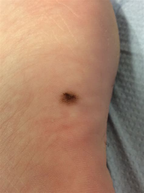 Mole In Bottom Of Foot - FootProAdvice.com