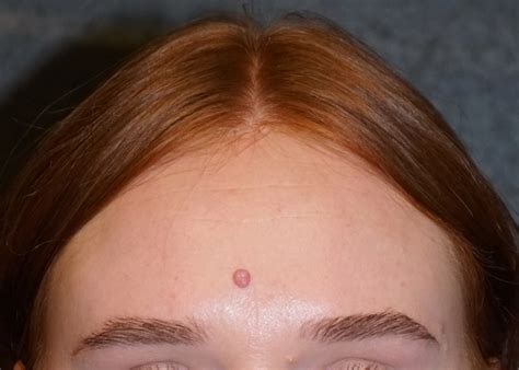 Mole on left forehead female. .  ...