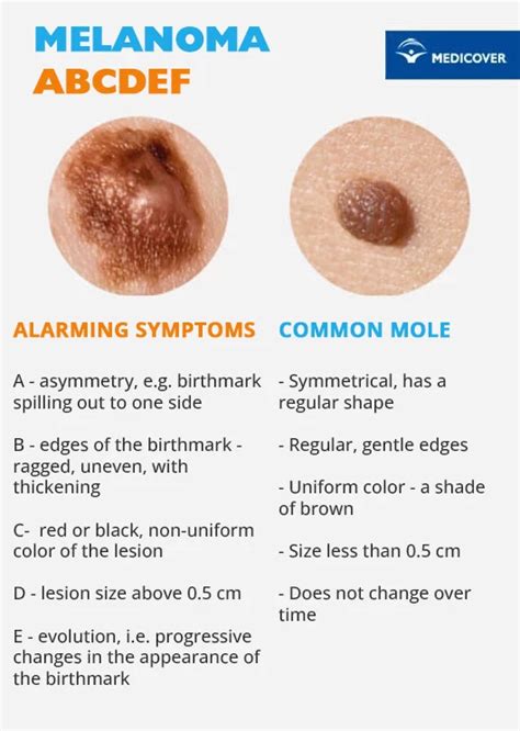 Moles - Diagnosis and treatment - Mayo Clinic