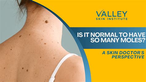 Moles What to Look for When to Worry Everyday Health