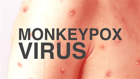 Monkeypox #funny video. Things To Know About Monkeypox #funny video. 