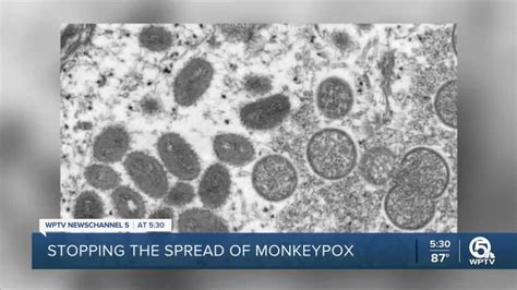 Monkeypox cases show signs of increasing - WPTV