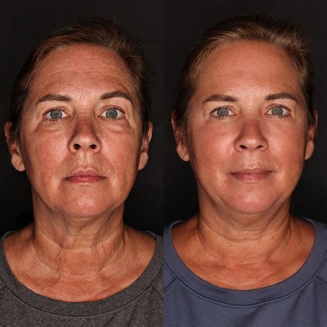 Morpheus 8 before and after. May 16, 2022 · Morpheus8 is a fractional aesthetic treatment that can be used to treat a range of skin conditions, including wrinkles, acne scars, sun damage, and age spots. Fractional aesthetics works by using microneedling to create smooth, even results. It works by using tiny needles to create shallow microchannels in the skin, which stimulates … 