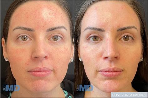 Morpheus before and after. Feel Spectacular. Look Spectacular. Be Spectacular. Come visit Dr. Sperling and our team of cosmetic experts and let us help you achieve the spectacular skin you deserve! 