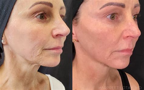 Morpheus8 before and after. Before and after 3 sessions of Morpheus8 radio-frequency skin needling, each spaced 1 month apart. Play video. What is Morpheus8 Radiofrequency Skin Needling? The Morpheus8 device is an advanced microneedling technology which delivers an intense collagen to each layer of facial skin. 