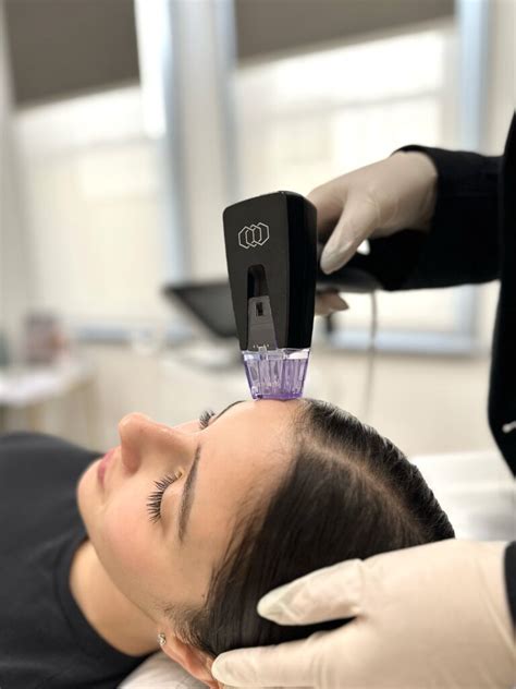 Morpheus8 Microneedling