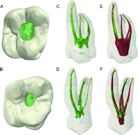 Morphology of Root Canal System of Maxillary and Mandibular Molars …