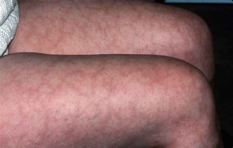 Nov 14, 2023 · Ringworm: Also known as tinea, this is a fungal skin infection that causes red, silver, brown, or gray ring-shaped patches of skin. These patches may be scaly, dry, or itchy. Ringworm can appear .... 
