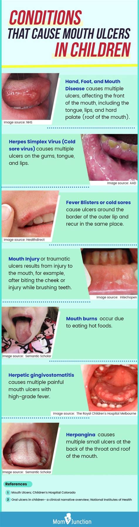 Mouth Ulcers In Children : Causes, Symptoms