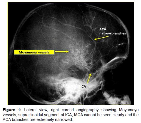 Moyamoya Läs om forskning & behandling - neuro.se Neuro