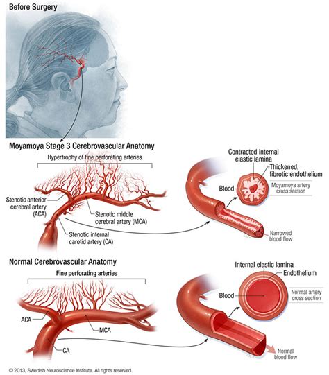 Moyamoya disease and moyamoya syndrome: Treatment and prognosi…