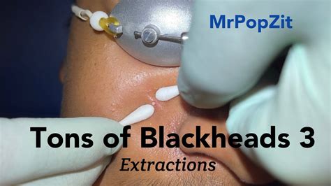 Nov 22, 2020 · Part 2 with my patient that has multiple blackheads, whiteheads, milia, and a few cysts. Over 150 close up pimple pops, over 16 minutes of just popping. I ed... .