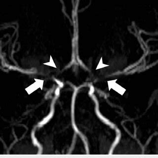 Mra circle of willis anatomy. .  <a href=https://turist66.ru/0zhzygk/woody...