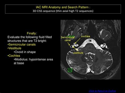 Mri iac for vertigo.  O. Initial imaging.  The two main categories of hear...
