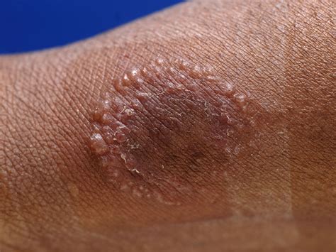 Mrsa pictures. A MRSA infection on the skin may look like a type of rash. A MRSA rash looks like red, swollen bumps on the skin. The bumps may be filled with fluid or pus. Some people may mistake a MRSA rash for a spider bite. However, unless you actually see the spider, the bumps are probably not from a spider bite. With MRSA, the infected area may also be: 