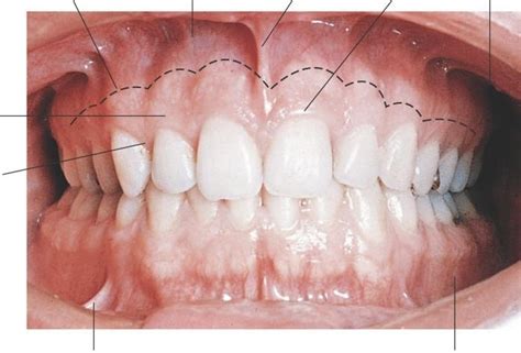 Muco-gingival junction FOR.org