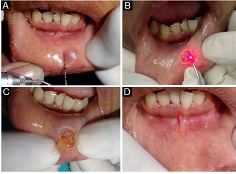 Mucocele operation