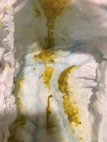 Mucoid Diarrhea