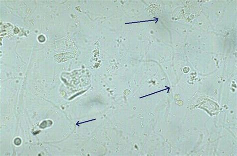 Such structures include mucus threads, leukocytes entrapped in mucus, rolled squamous epithelial cells, aggregates of amorphous urates, calcium oxalate .... 
