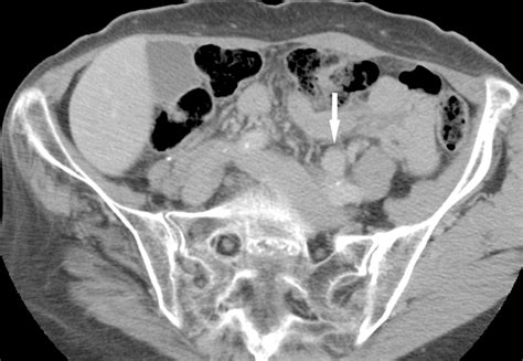 Multi–Detector Row CT Urography in the Evaluation of Hematuria